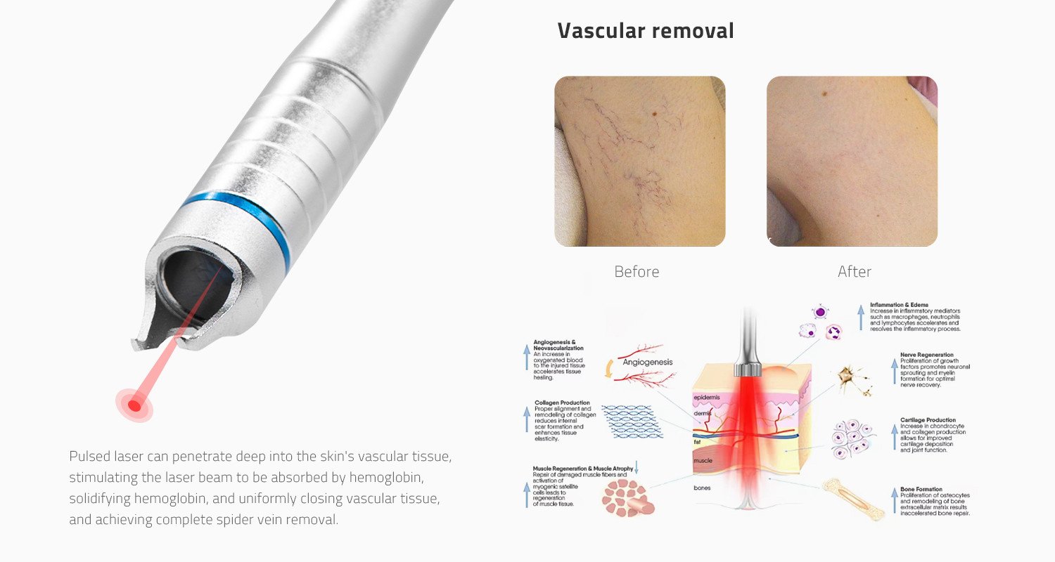 Photon-ENDOLIFT1470nm 1470 nm Laser Platform product detail 3