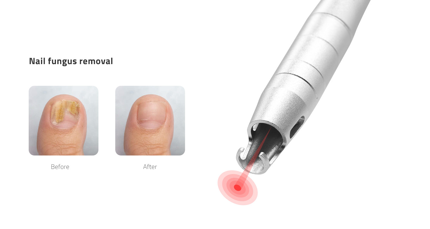 Photon-ENDOLIFT1470nm 1470 nm Laser Platform product detail 4