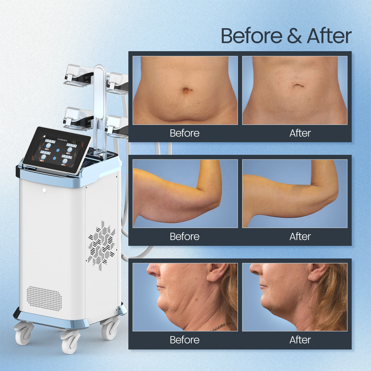 Vortex-Cro774 360-degree Cryolipolysis Platform product detail 8
